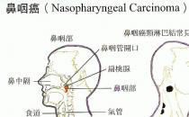 鼻咽癌的早期癥狀有哪些？