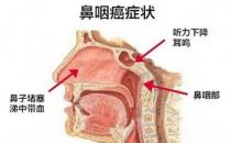 鼻咽癌有望靠疫苗預(yù)防控制