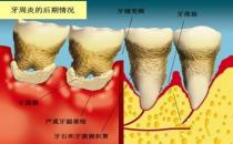 牙周炎會誘發(fā)類風濕關節(jié)炎