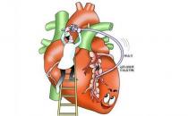 冠心病能不能治好呢