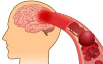 防中風控制好六大因素 生活中對中風病的日常誤區(qū)