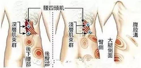 湛江崇愛(ài)康復(fù)醫(yī)院科普如何防治肌筋膜炎 以真誠(chéng)來(lái)服務(wù)患者