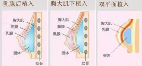 北京韓嘯醫(yī)生：為什么假體隆胸手術之后胸部疼痛
